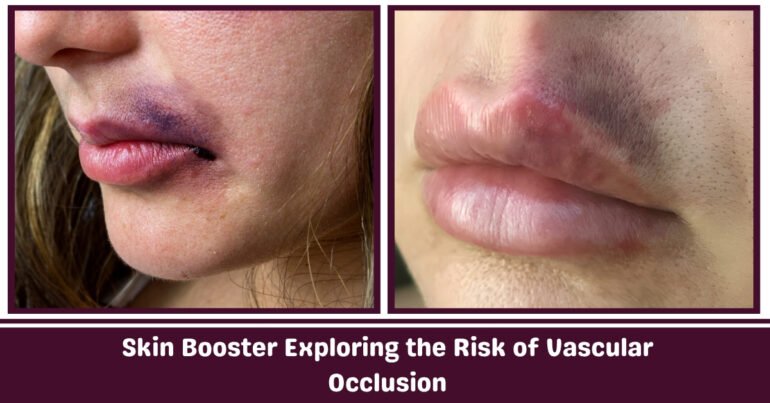 Skin Booster Exploring the Risks of Vascular Occlusion